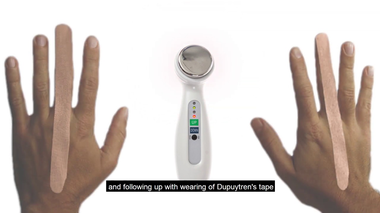 Dupuytren's Wand and Dupuytren's Tape