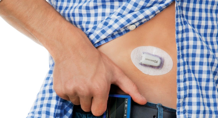 Global Continuous Glucose Monitoring Market- Global Industry Insights, Trends And Forecast, 2017 – 2025