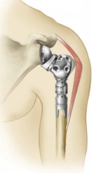 Humeral Implants Market Trends, Regulations And Competitive Landscape Outlook To 2027