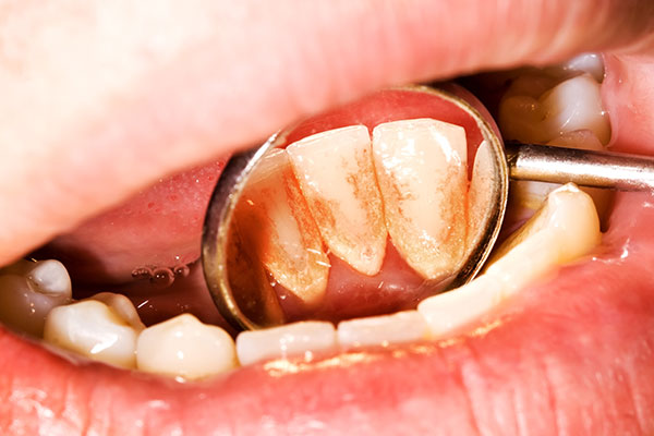 Introducing The Best Dental Implant Surgery In Affordable Cost