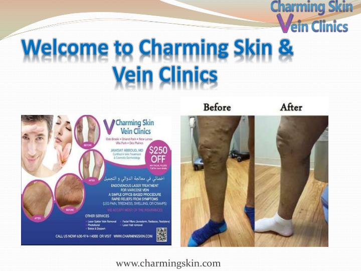 laser vein treatment Chicago for effective spider vein removal