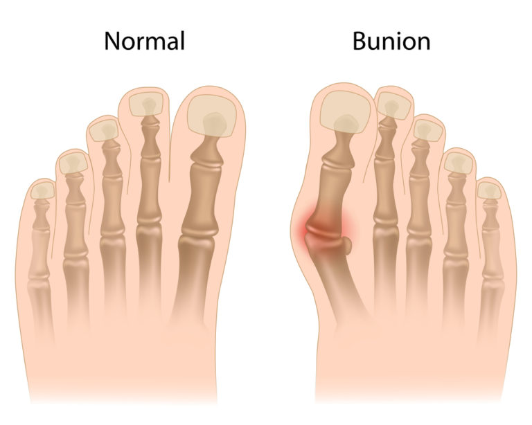PLACE YOUR APPOINTMENT TODAY WITH BUNION SURGERY BROOKLYN!
