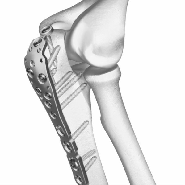 Siora Surgicals Introduces ISO Certified Locking Plates